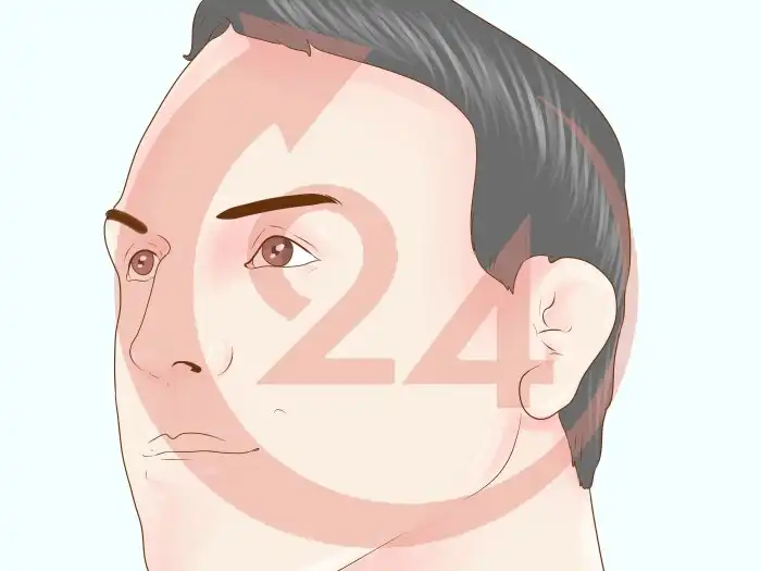 Is cauliflower ear permanent?