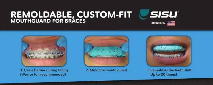 Can you play rugby with braces