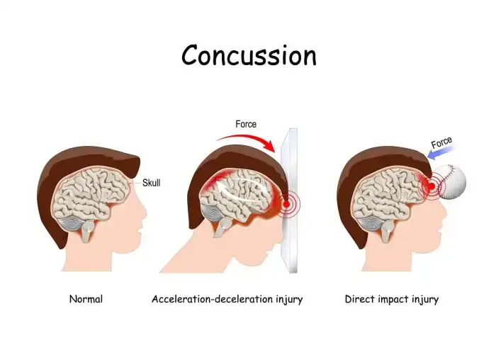 Does rugby cause brain damage