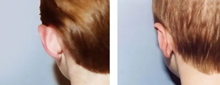 How to remove cauliflower ears?
