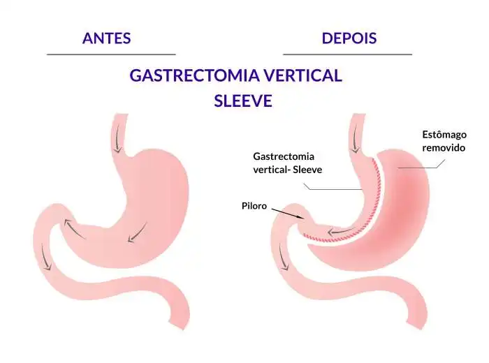 SLEEVE - Gastrectomia vertical Metodo Sleeve Cirurgia Bariatrica