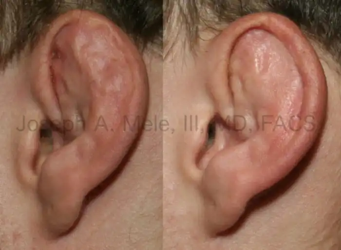 How to remove cauliflower ears?