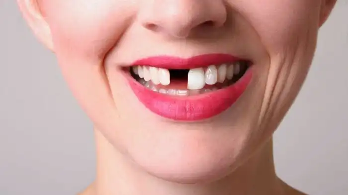 Foto de Um Dente De Plástico Falso Odontologia Dentes Protéticos Placas ... Foto de Um Dente De Plástico Falso Odontologia Dentes Protéticos Placas ...