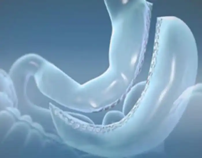 CIRURGIA DA BARIÁTRICA: BYPASS OU SLEEVE ? DIFERENÇAS ? QUAL A MELHOR ... Metodo Sleeve Cirurgia Bariatrica