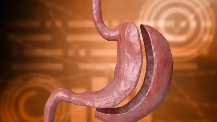 Saiba mais sobre o método Sleeve – Dr. Victor Loverso Saiba mais sobre o método Sleeve – Dr. Victor Loverso