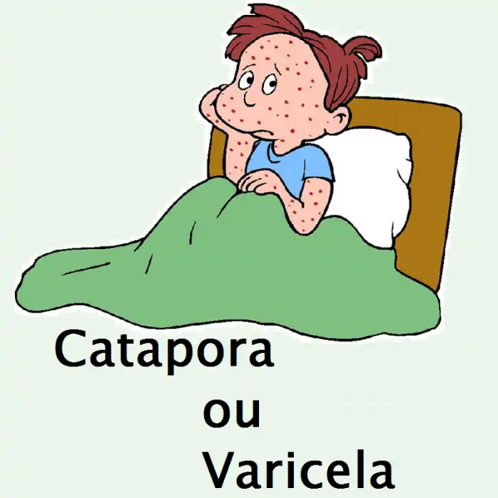 Varicela E Catapora É A Mesma Coisa