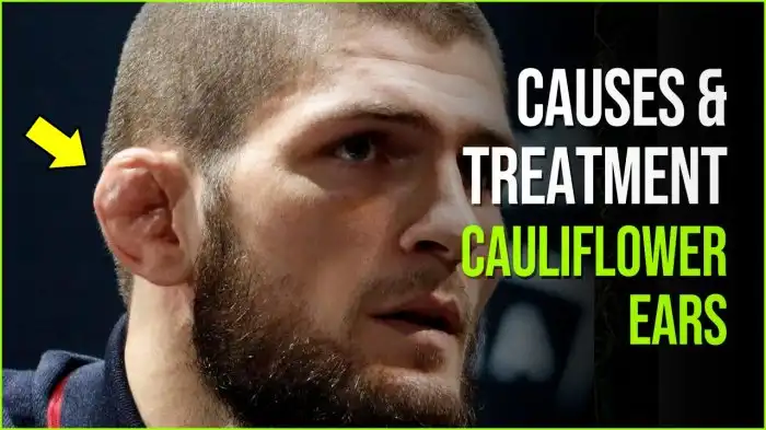 What happens if you ignore cauliflower ear?