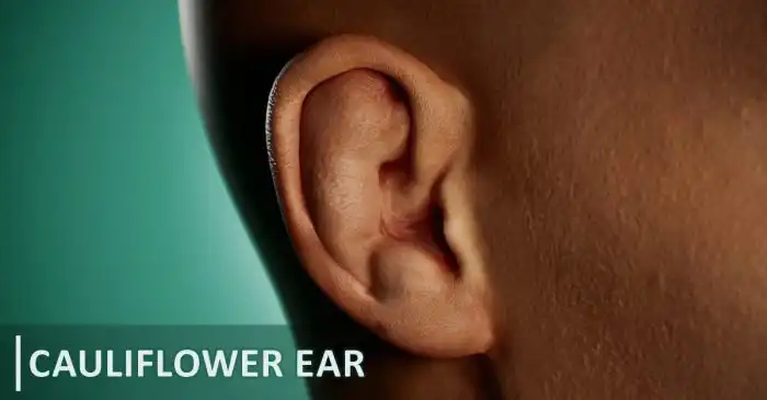 Ear cauliflower ears fighters ufc weird thesun treatment bjj happen prevent fighter