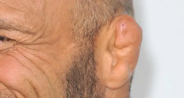 What happens if you ignore cauliflower ear?