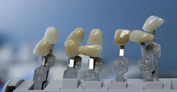 Dente Provisório é Colocado Antes da Prótese Fixa Dente Falso Provisório