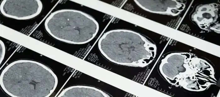 Declínio cognitivo progressivo: causas + como identificar | Vitasay Significado Da Palavra Declínio