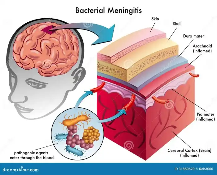 Meningite Bacteriana