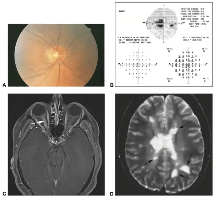 Neurite vestibular: remédios naturais para combatê-la - Melhor com Saúde Neurite Tem Cura