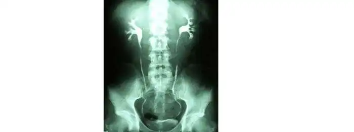 Urografia Excretora, Saiba Mais Sobre o Exame Urografia Excretora, Saiba Mais Sobre o Exame