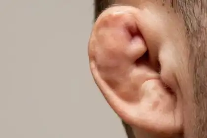 Does cauliflower ear affect hearing?