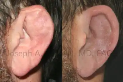 Why can't cauliflower ear be fixed?