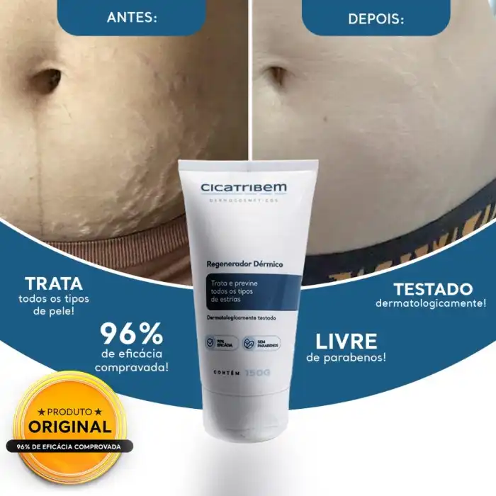 Creme para Estrias Cicatribem 150g - Trata Todos os Tipos de Estrias ...