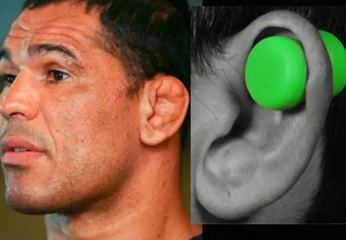 How to remove cauliflower ears?