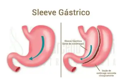 Cirurgia Bariátrica Sleeve - Dr Marcello Giovani - Gastrocirurgia