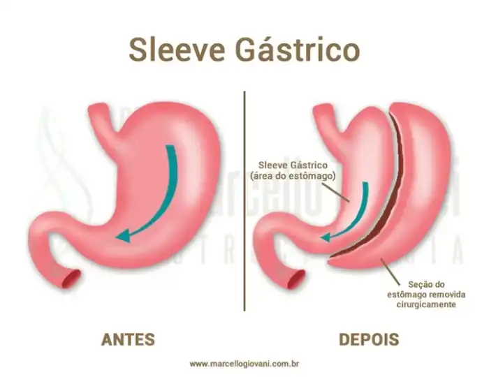 Cirurgia Bariátrica Sleeve - Dr Marcello Giovani - Gastrocirurgia